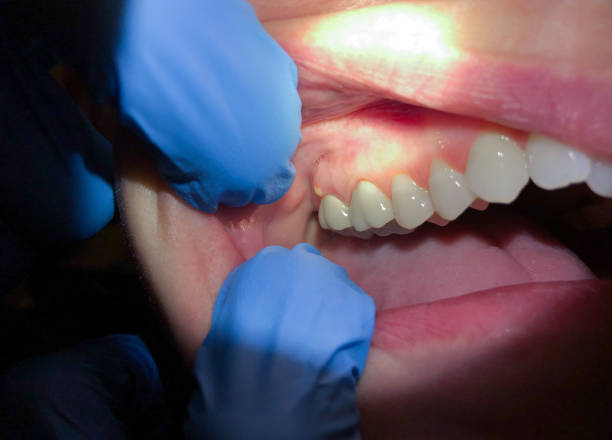 Best Emergency Tooth Extraction in Briarcliff, TX