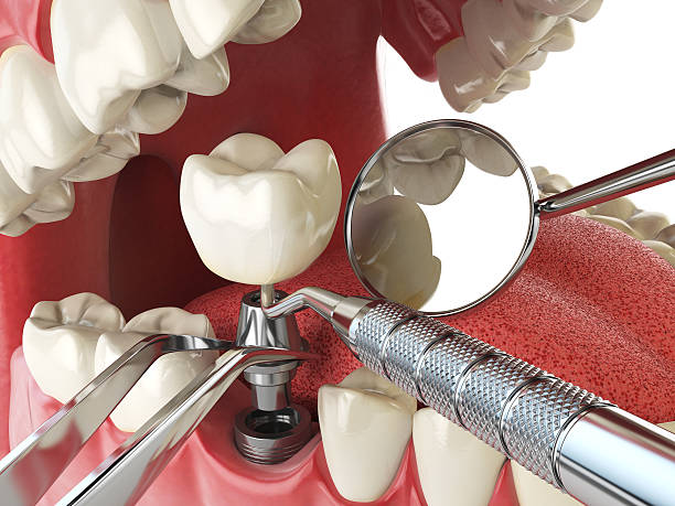 Best Emergency Treatment for Dental Infections or Abscesses in Briarcliff, TX